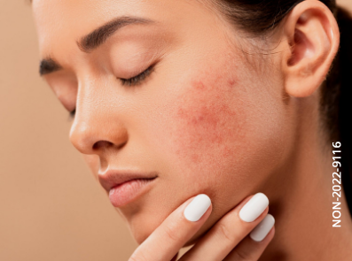 L’acne si manifesta quando i pori della pelle si ostruiscono e si infiammano.
